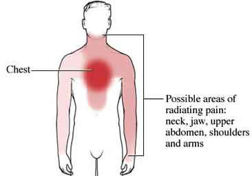 Angina pectoris ?? | Farez's Blog pain assessment body diagram arms 