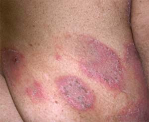 skin, Itchy