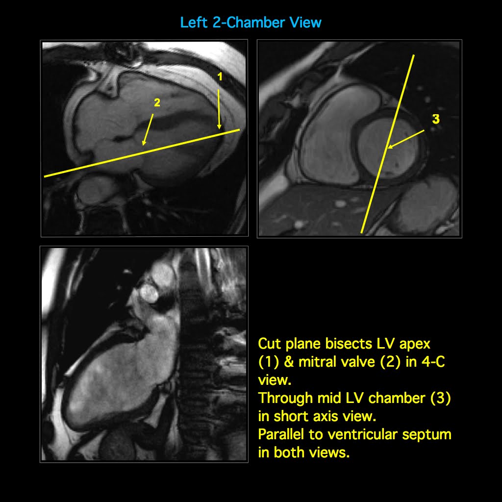 cardiac mri