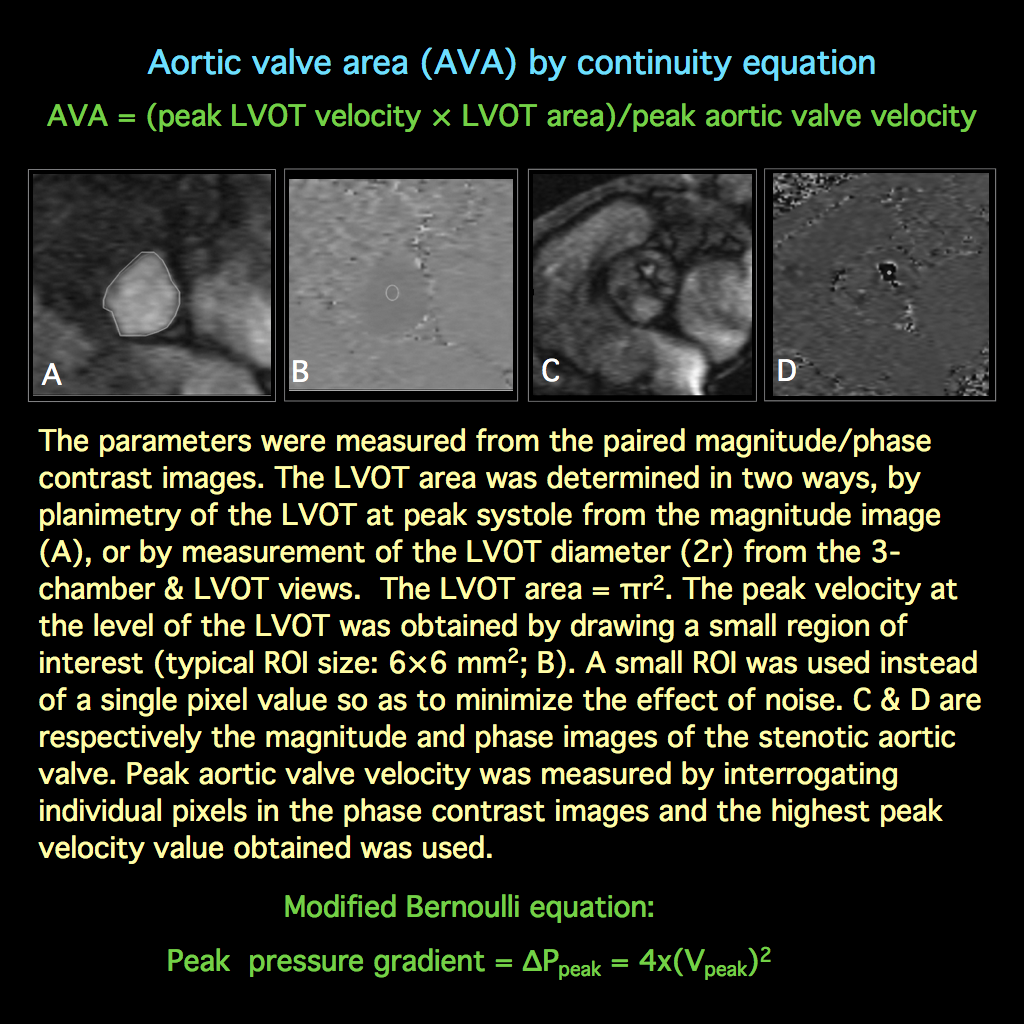 MRI BLOG CMR Imaging of Aortic Valve