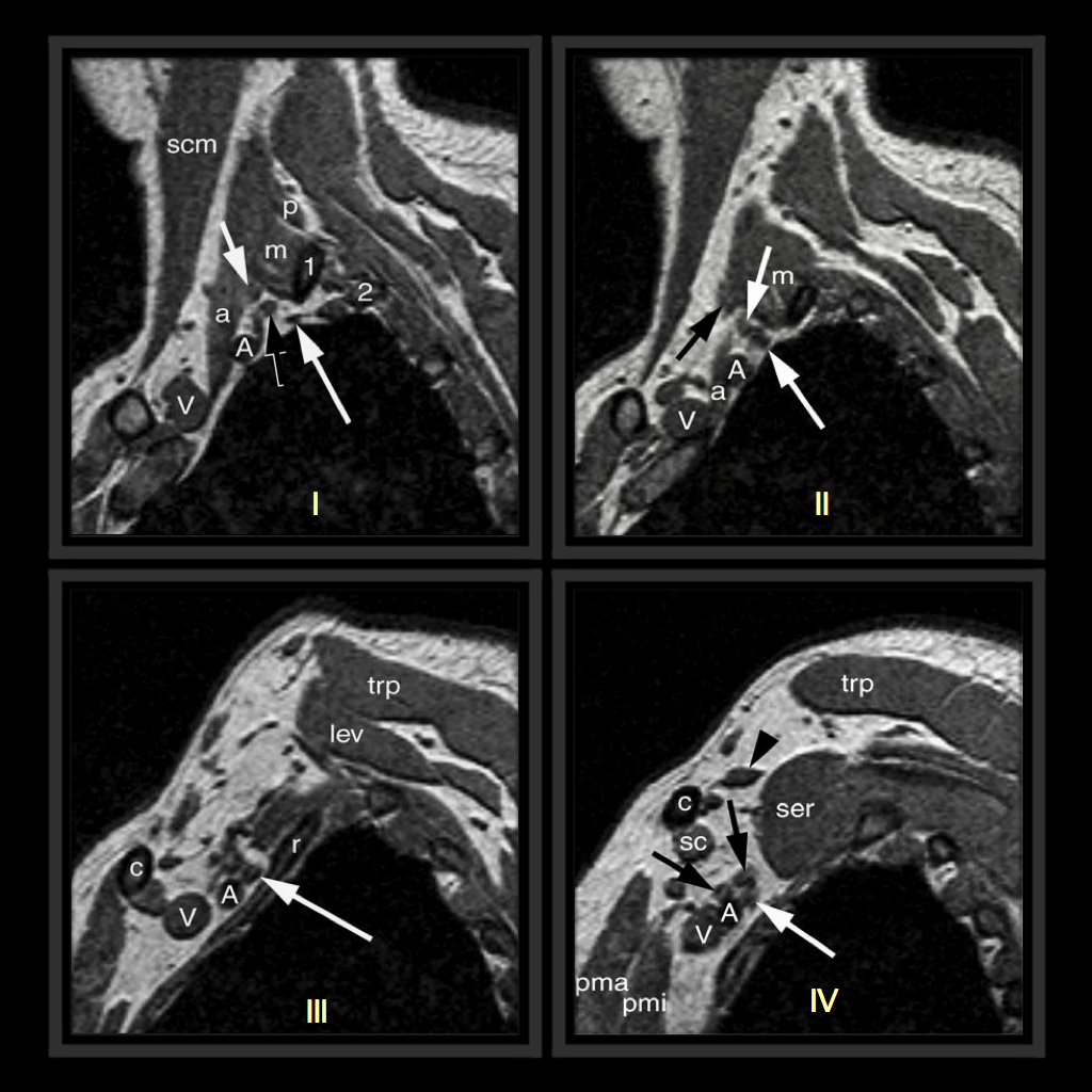 MRI BLOG Brachial Plexus MRI (I/II)
