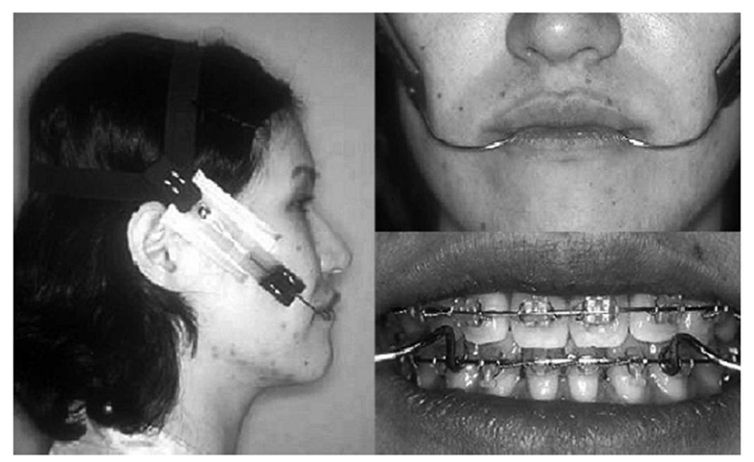 ORTODONTIA CONTEMPORÂNEA Tratamento da Classe lll em adultos utilizando aparelho extrabucal J