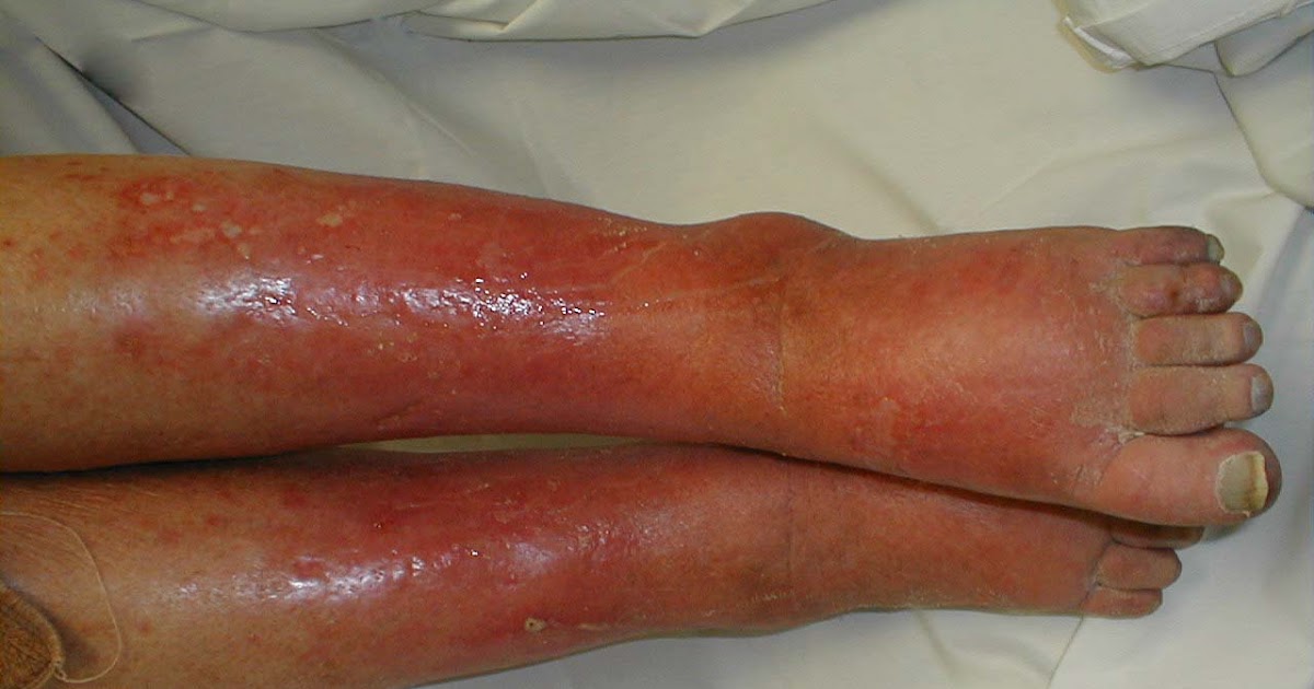 Doctors Gates: Cellulitis PIC