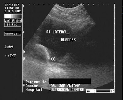 ON - RADIOLOGY: Large urinary bladder calculus (by Pie Scanner 100