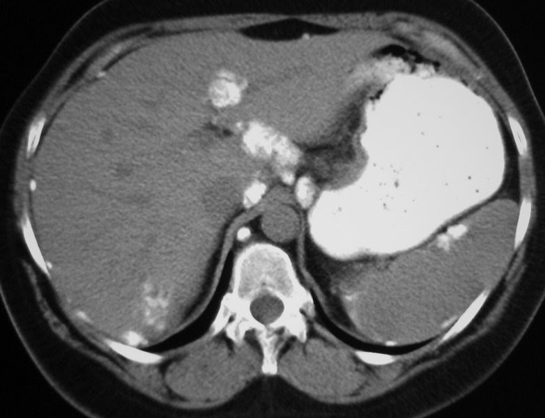 ON - RADIOLOGY: Causes of Calcified Liver Masses on CT