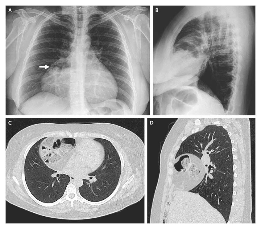 ON RADIOLOGY Radiological images of Hernia