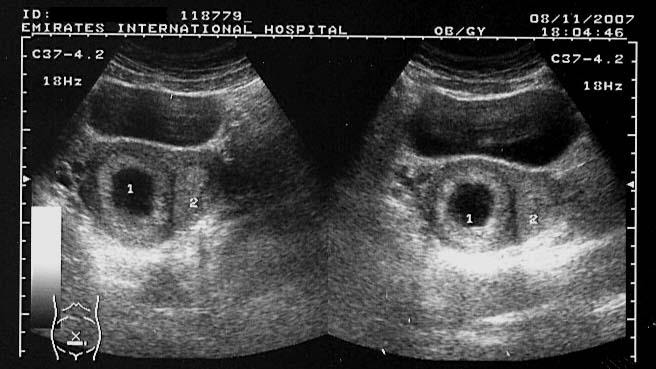 ON - RADIOLOGY: Ultrasound images of Bicornuate uterus with gestation sac