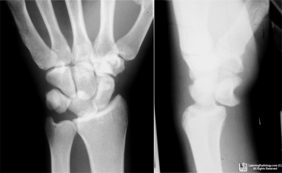 ON RADIOLOGY Lunate bone Dislocation