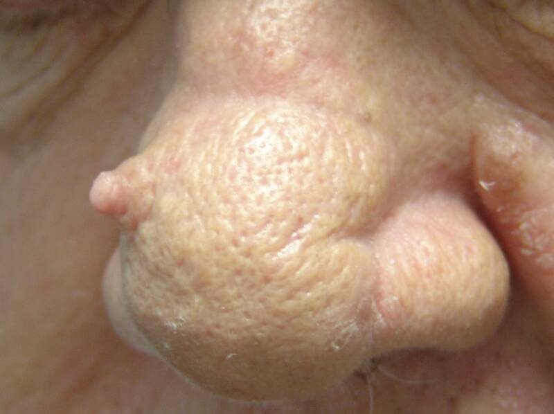 Doctors Gates Cutaneous Horn of the Nose