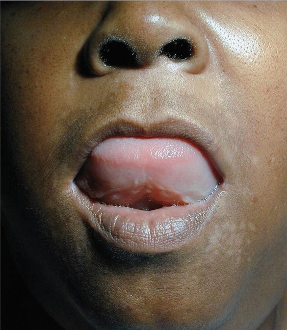 Acei Angioedema