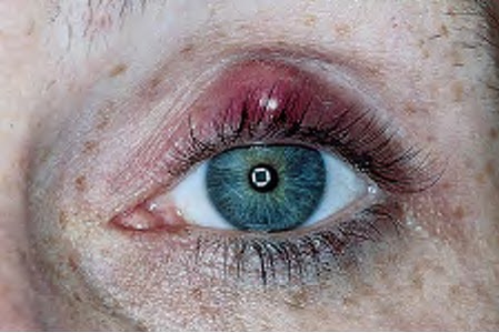 Focal swelling and erythema at the lid margin are seen in this hordeolum.