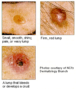 Beginning Skin Cancer