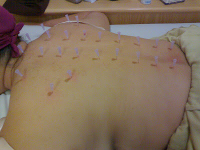 Dry Needling