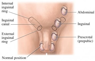 Ectopic+testis