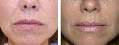 Restylane Before and after