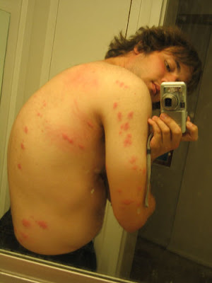 Bed Bug Attack