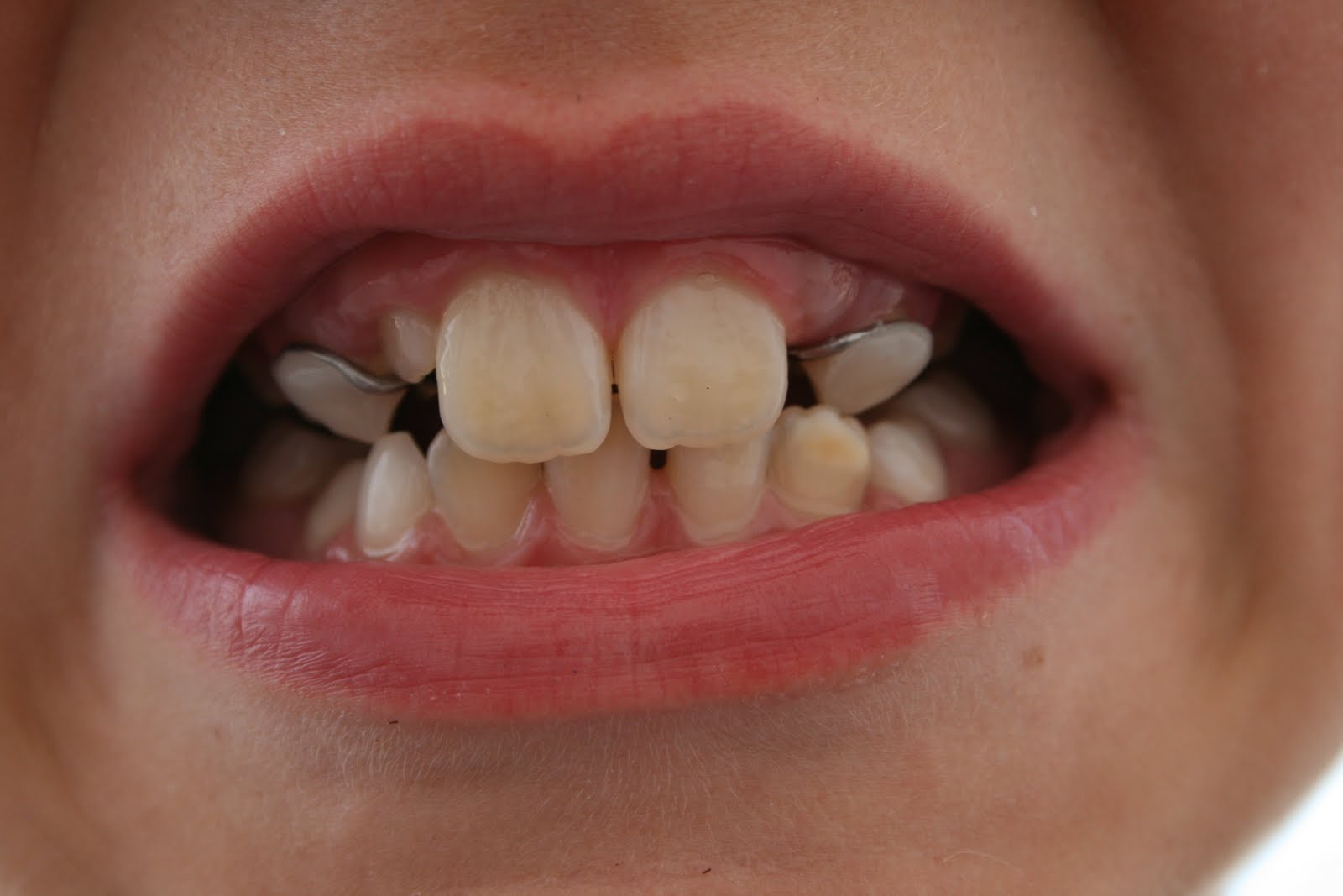 [Matts+braces+(6).JPG]