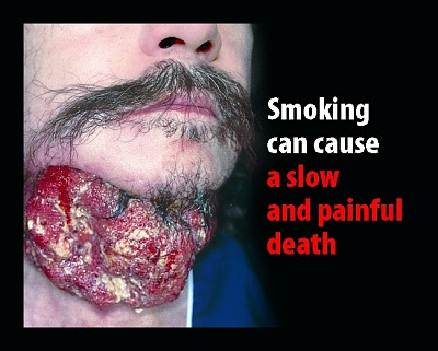 diseases by smoking