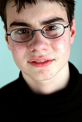 [acne.JPG]