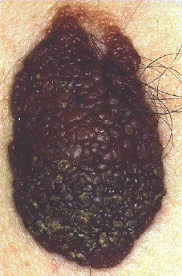 Hairy Nevus Birthmark