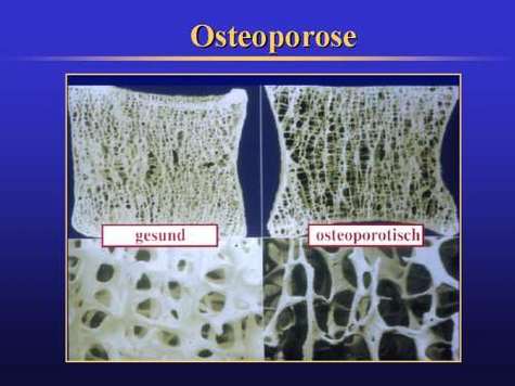 osteoporose.jpg