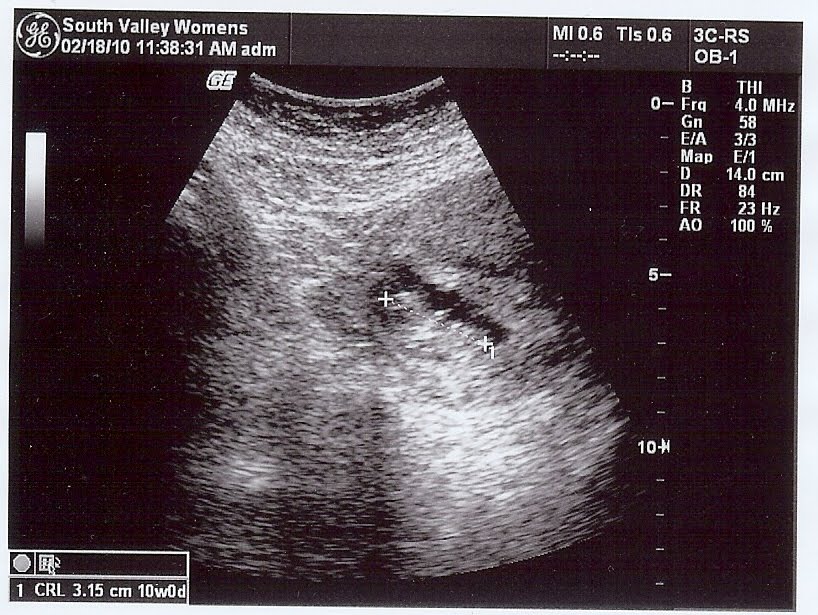 [10+week+ultrasound.jpg]