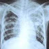 Penyakit TB atau Tuberkulosis --- Dulu Namanya TBC