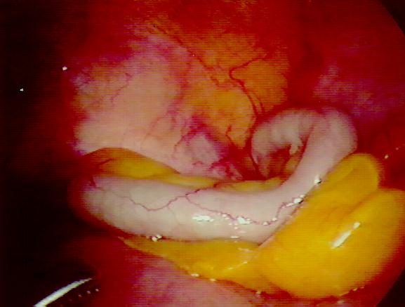 The appendix, they said,