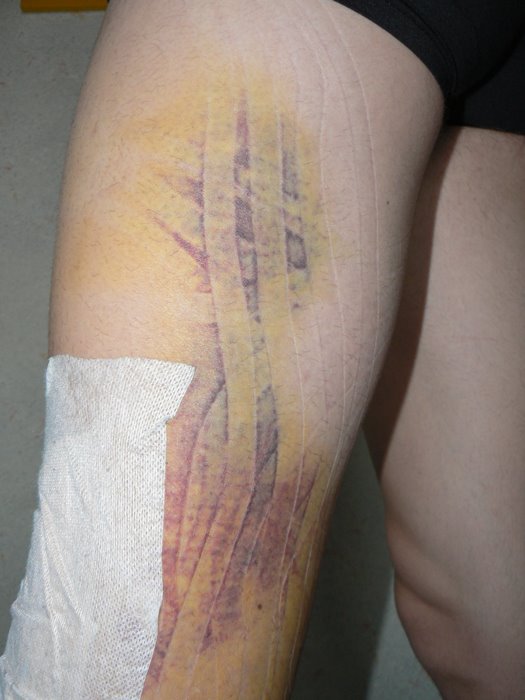 [résultat-hématome.jpg]