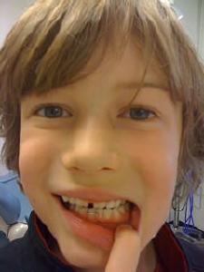 Klaus' new teeth