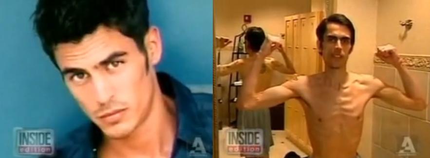 Anorexia Masculina A