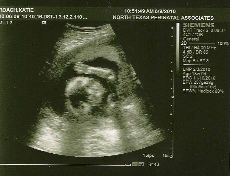 Sonogram Pictures Of Girls At 18 Weeks
