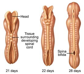 Spina Bifida Adults