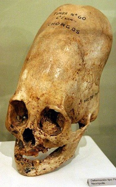 PICS DOT COM: Deformation of the Human Skull