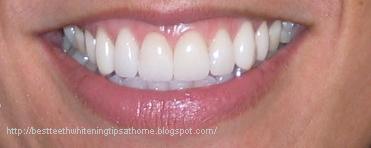 http://3.bp.blogspot.com/_asEUPJiFcro/S6715YO1GJI/AAAAAAAAAI4/hRAyGmFNsGY/s1600/natural+teeth+whitening+-+best+teeth+whitening.jpg