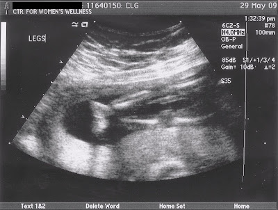sonogram 5 weeks. 5+week+fetus+ultrasound