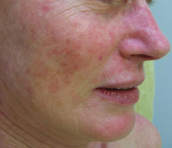 Rosacea Nose