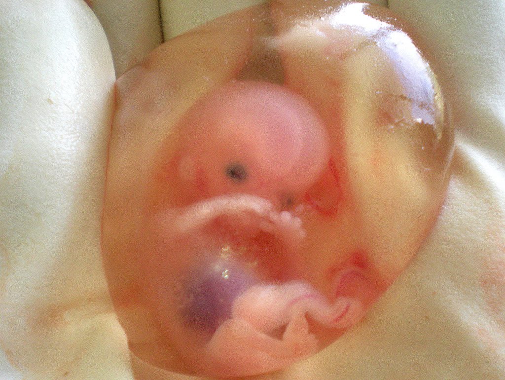 [Abortion.jpg]