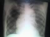 Cliché suspect du cancer du poumon