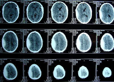 Ct+scan+of+brain