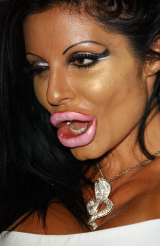 Plastic Surgery   on Bad Lip Injections Gone Wrong   Cosmetic Plastic Surgery