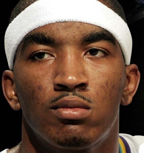 celebrities with acne. J. R. Smith Acne