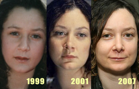 Sara Gilbert plastic surgery