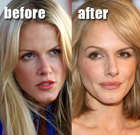 Monet Mazur Lip Augmentation