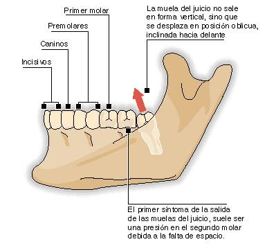 las muelas del juicio