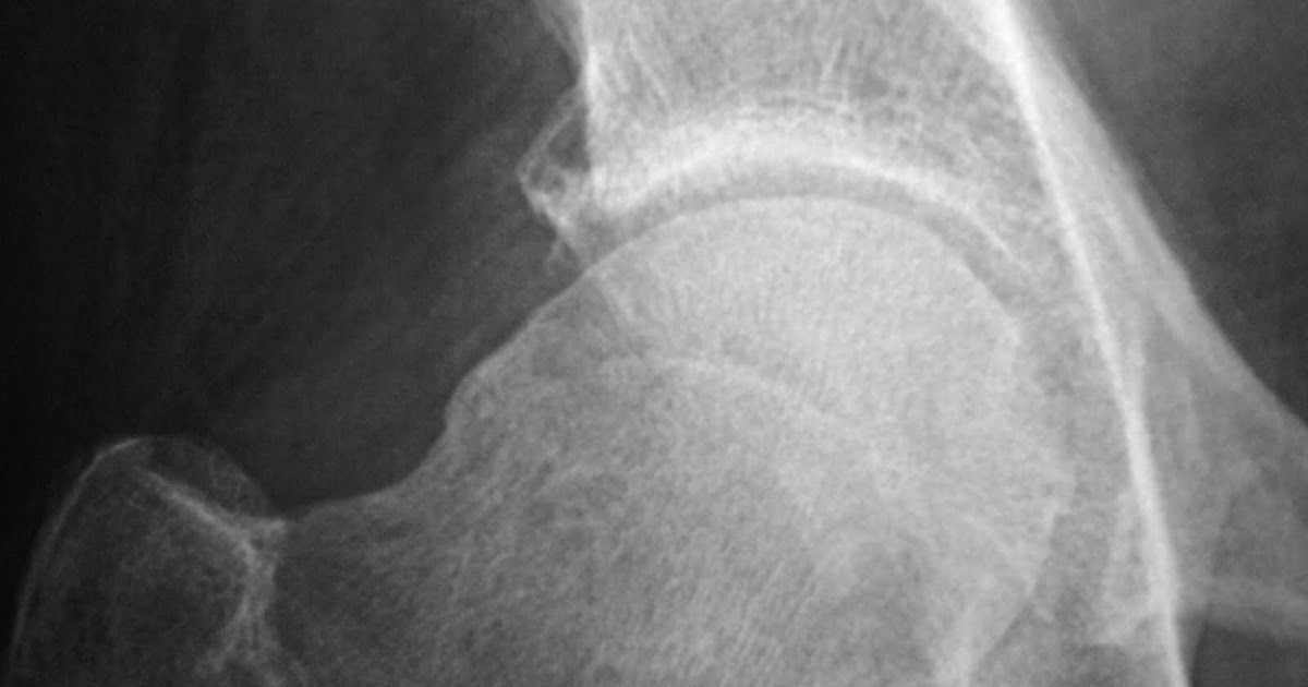 Daily Dose Pistol grip deformity