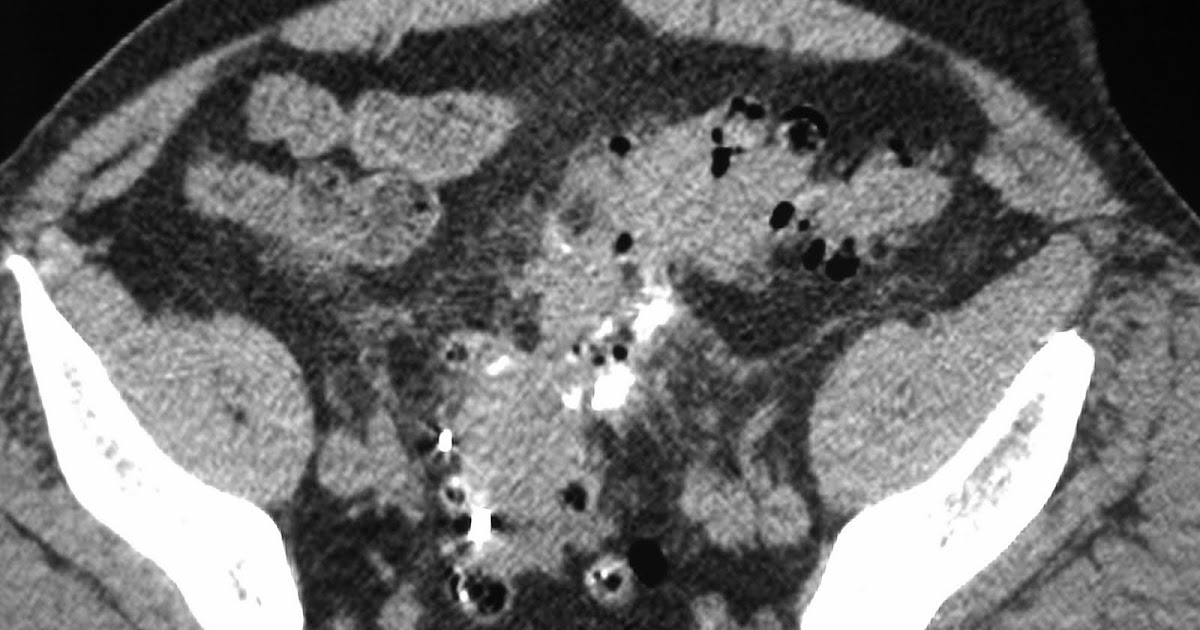Daily Dose: Colovesical fistula