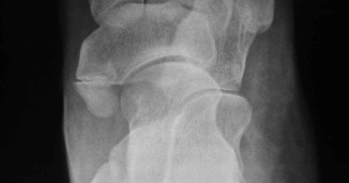 Daily Dose Accessory navicular or fracture?