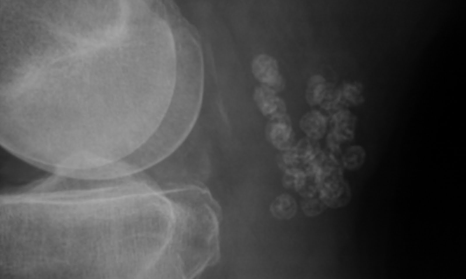 Daily Dose ? Synovial osteochondromatosis of Baker's cyst