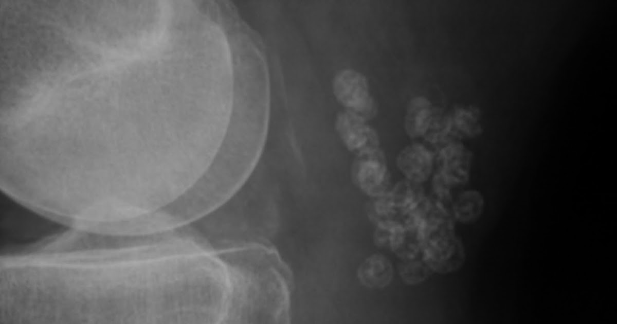 Daily Dose ? Synovial osteochondromatosis of Baker's cyst